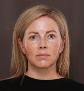 Before Image: Moxi & BBL (Broad Band Light)