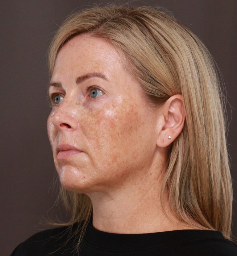 Before Image: Moxi & BBL (Broad Band Light) - left-front-oblique