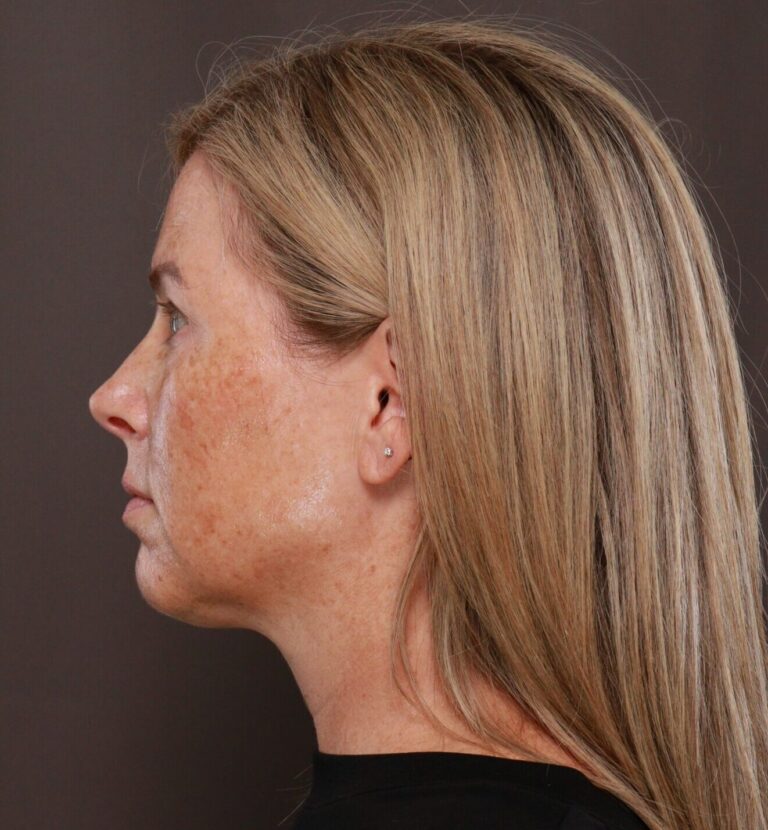 Before Image: Moxi & BBL (Broad Band Light) - left-side