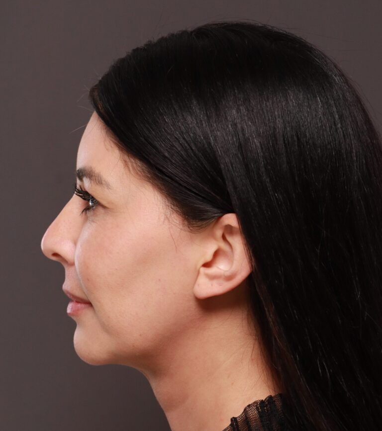 Before Image: Dermal Filler to Lower Face - left-side