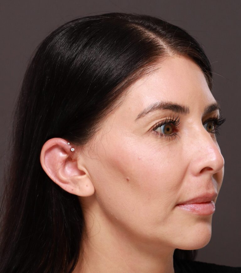 Before Image: Dermal Filler to Lower Face - right-front-oblique