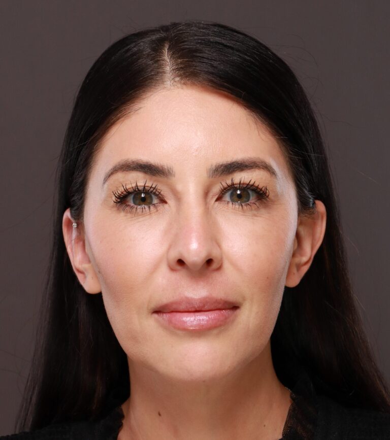 Before Image: Dermal Filler to Lower Face - front