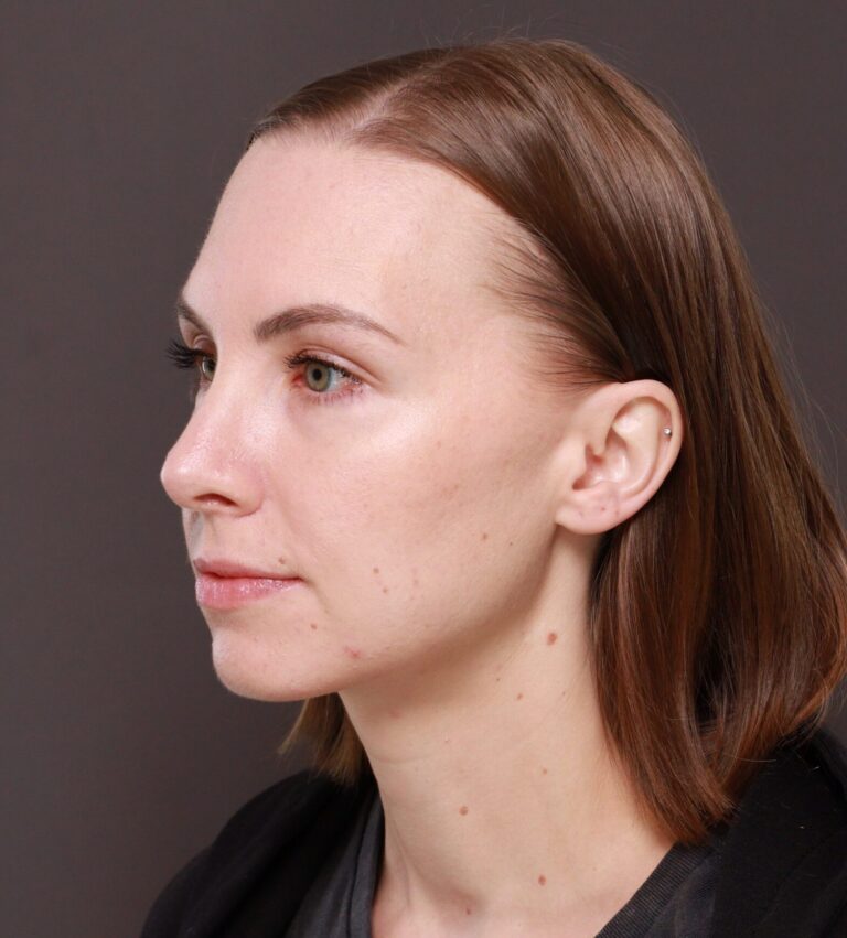 After Image: Rhinoplasty by Dr. Henstrom - left-front-oblique