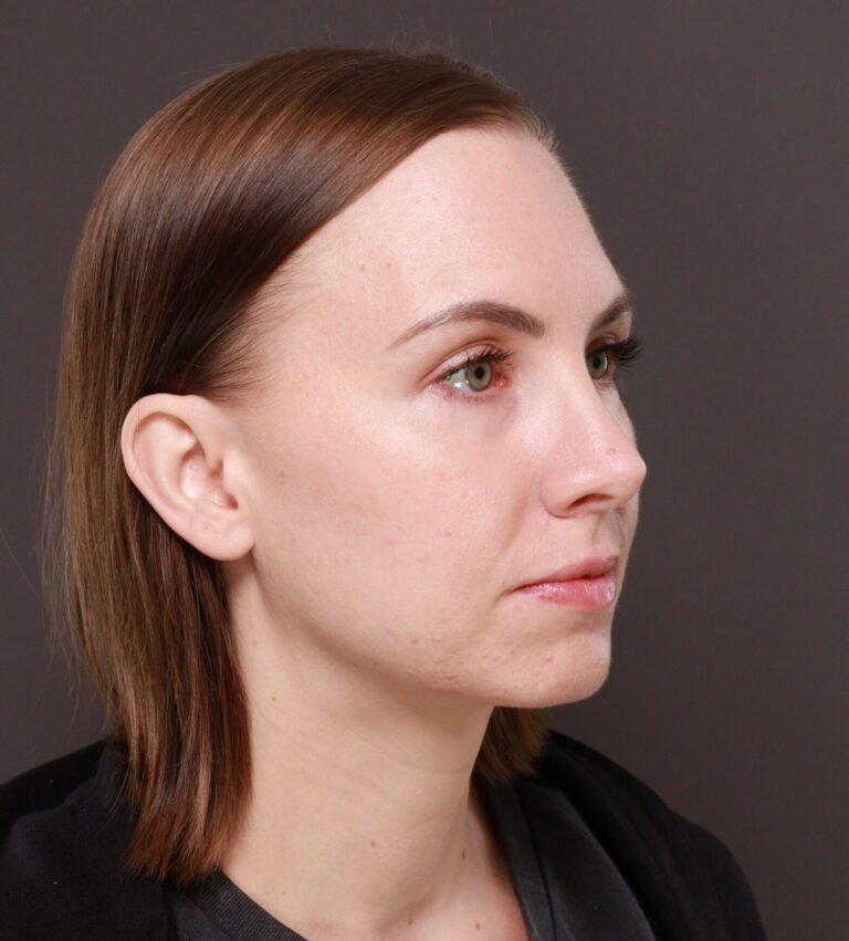 After Image: Rhinoplasty by Dr. Henstrom - right-front-oblique