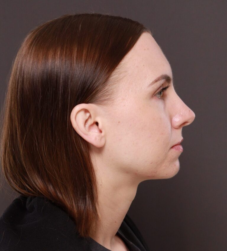 After Image: Rhinoplasty by Dr. Henstrom - right-side