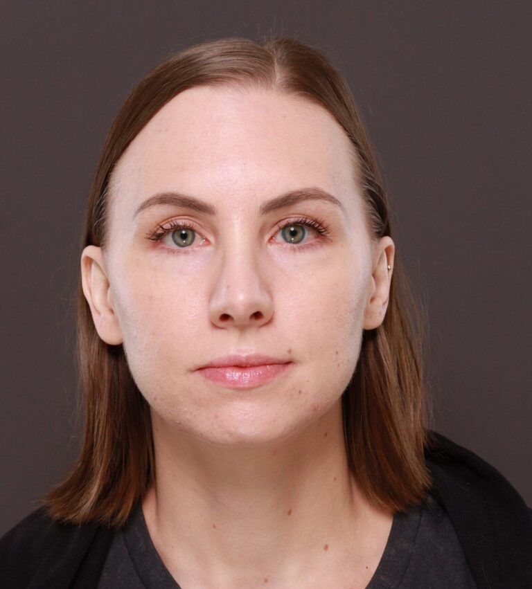 After Image: Rhinoplasty by Dr. Henstrom - front