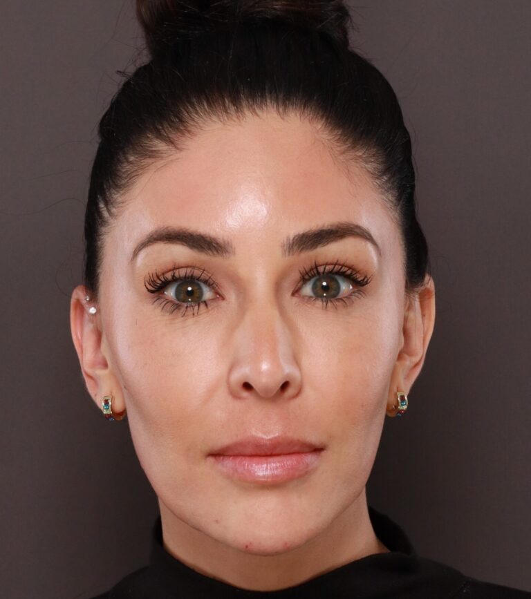 After Image: Dermal Filler to Lower Face - front