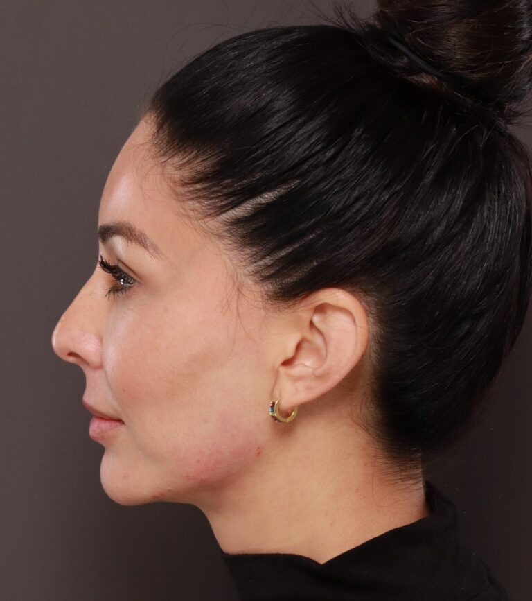 After Image: Dermal Filler to Lower Face - left-side
