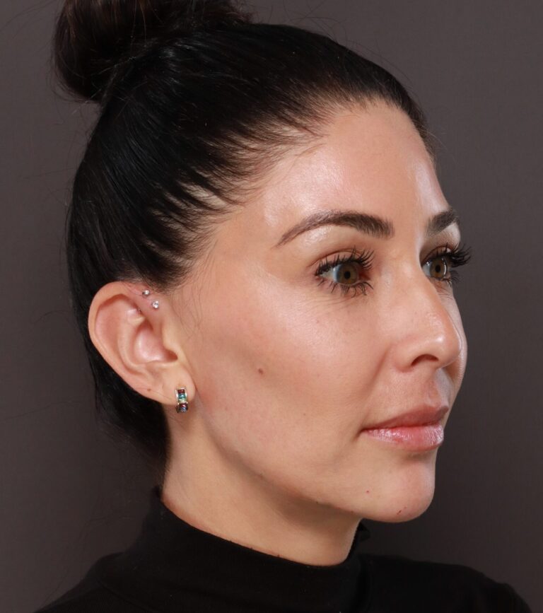 After Image: Dermal Filler to Lower Face - right-front-oblique