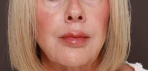 After Image: Lip Lift by Dr. Henstrom