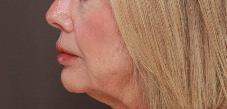 After Image: Lip Lift by Dr. Henstrom - left-side