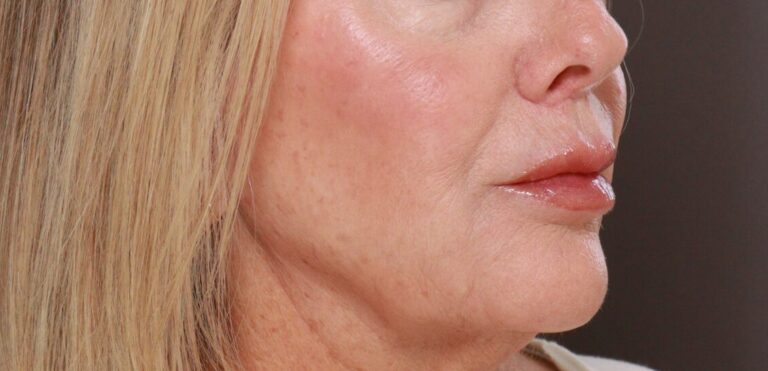 After Image: Lip Lift by Dr. Henstrom - right-front-oblique