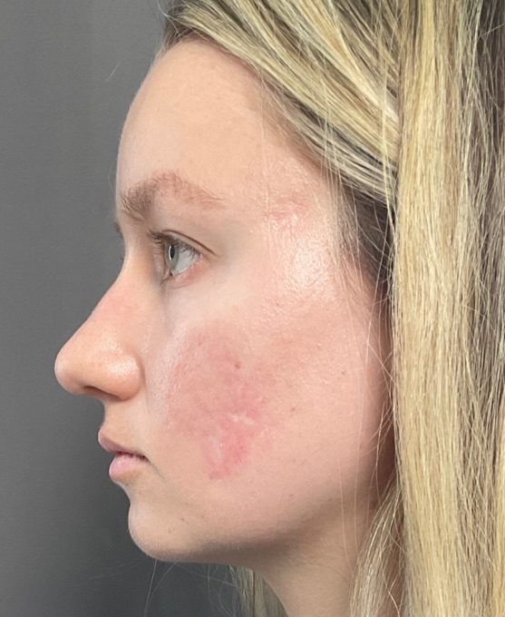 Before Image: Halo and BBL Laser Resurfacing by: Katy - left-side