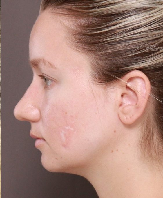 After Image: Halo and BBL Laser Resurfacing by: Katy - left-side