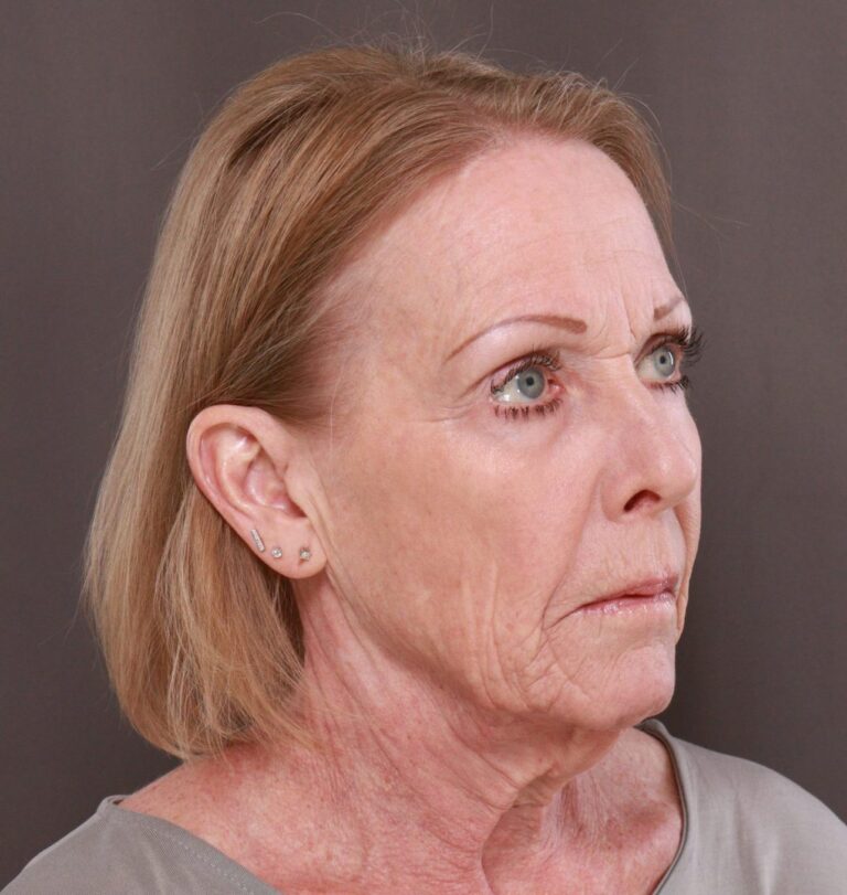 Before Image: Facelift, Browlift, Lip Lift & Contour TRL by Dr. Manning - right-front-oblique