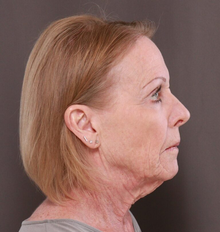 Before Image: Facelift, Browlift, Lip Lift & Contour TRL by Dr. Manning - right-side