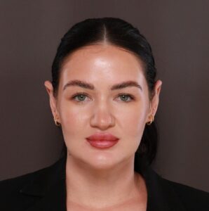 After Image: Otoplasty by Dr. Henstrom