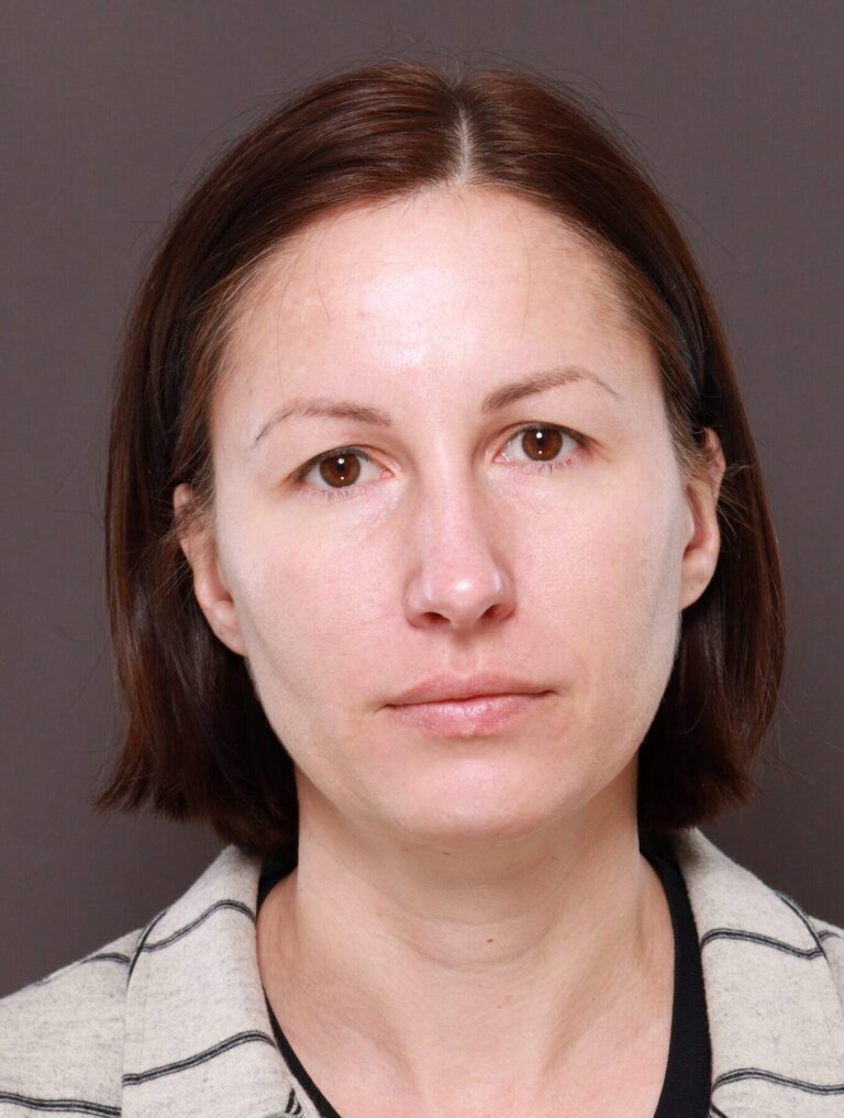 Before Image: Browlift by Dr. Manning - front