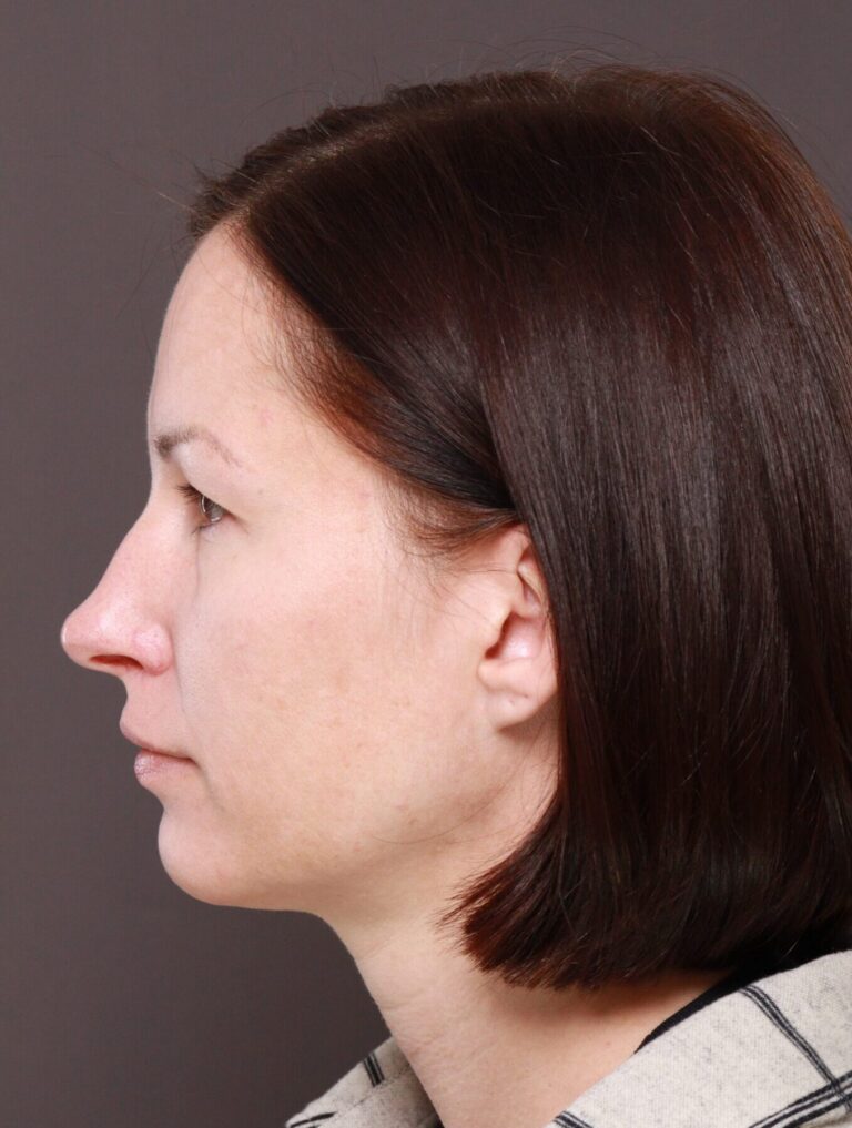 Before Image: Browlift by Dr. Manning - left-side