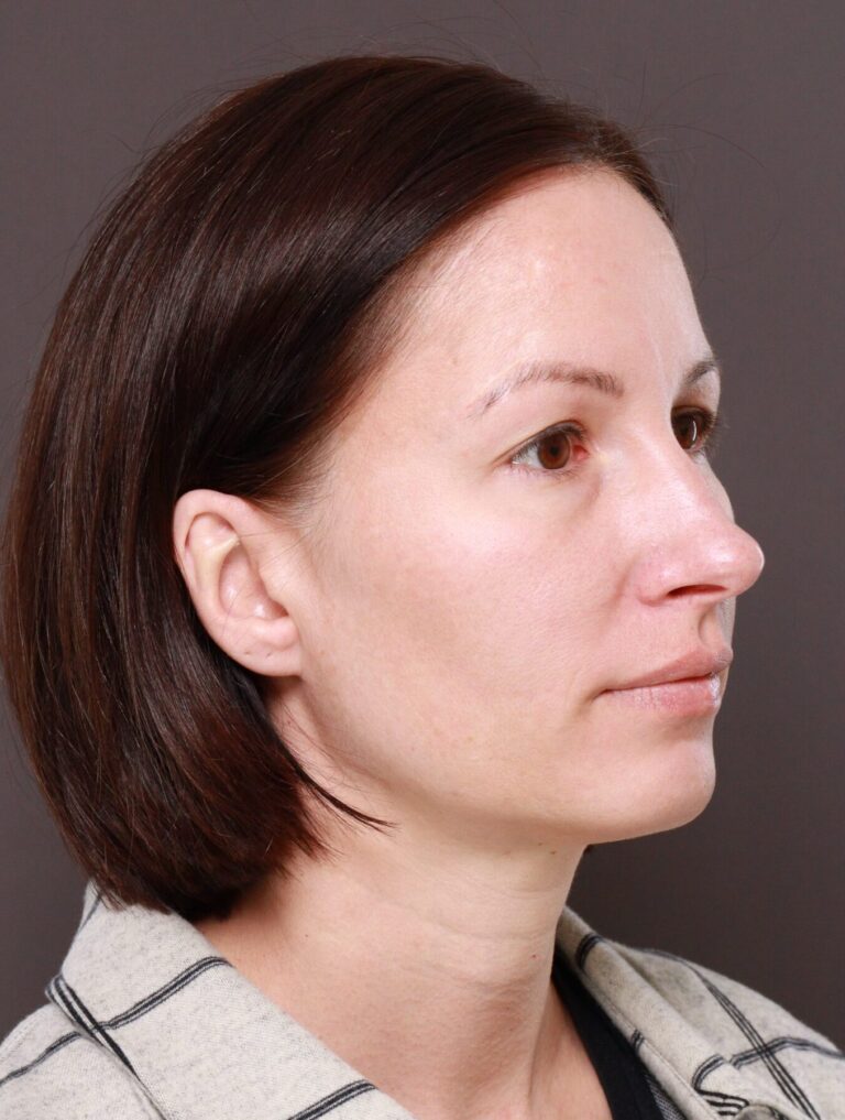 Before Image: Browlift by Dr. Manning - right-front-oblique