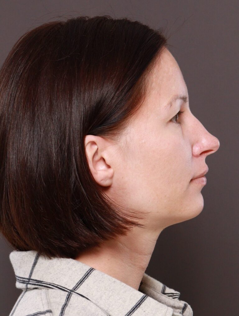 Before Image: Browlift by Dr. Manning - right-side