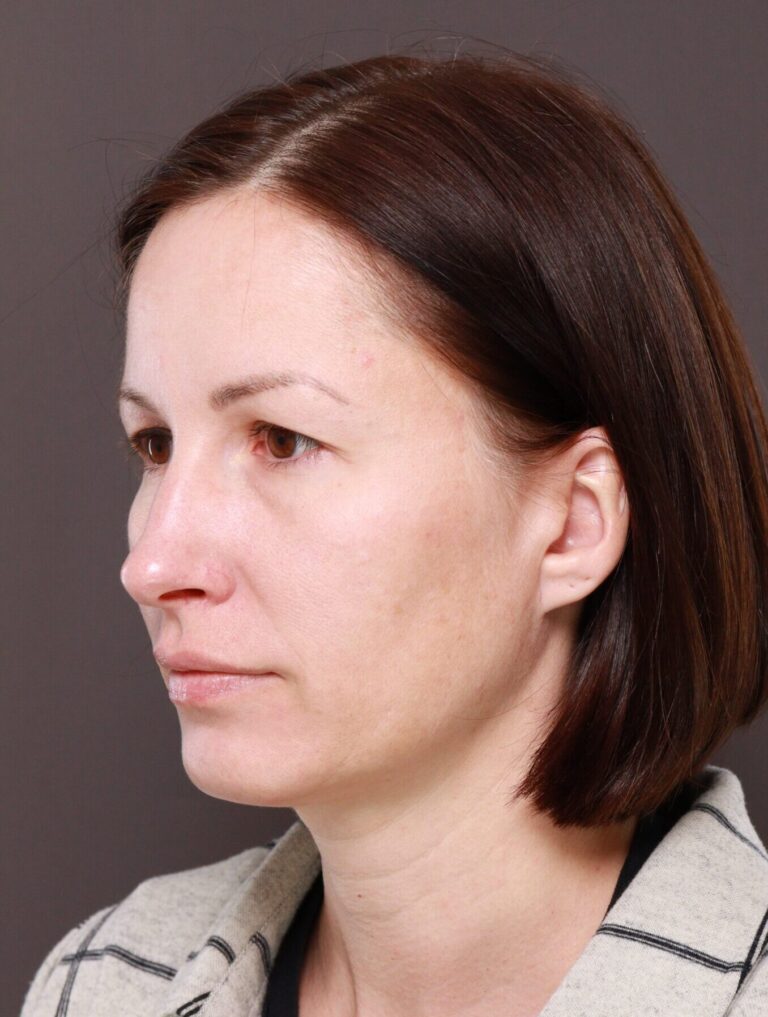 Before Image: Browlift by Dr. Manning - left-front-oblique