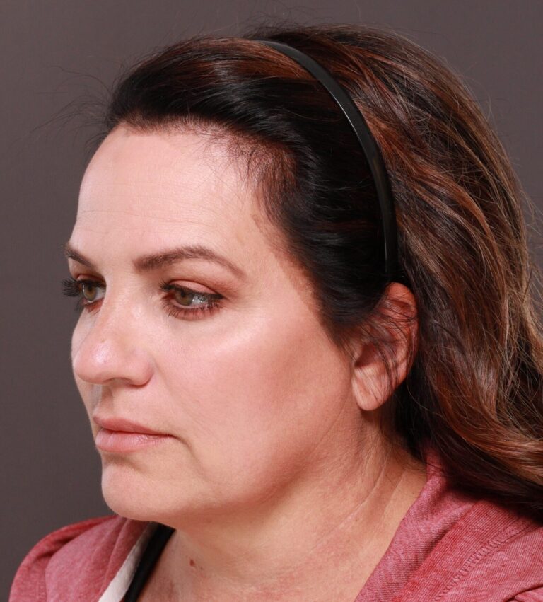 Before Image: Facelift and Browlift by Dr. Thompson - left-front-oblique