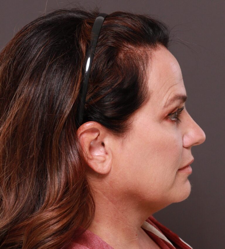 Before Image: Facelift and Browlift by Dr. Thompson - right-side