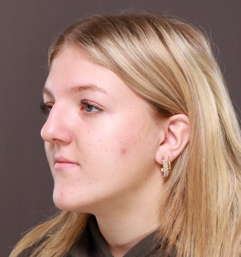 Before Image: Rhinoplasty by Dr. Manning - left-front-oblique