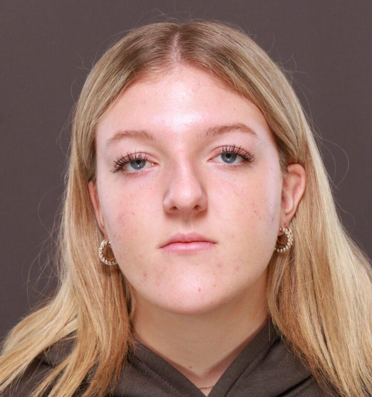 Before Image: Rhinoplasty by Dr. Manning - front