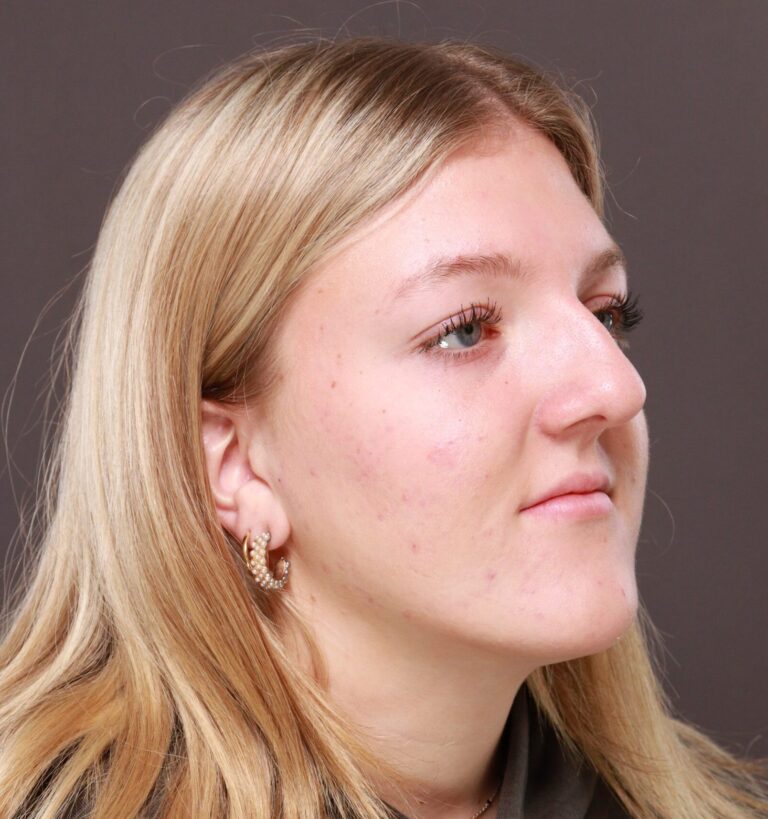 Before Image: Rhinoplasty by Dr. Manning - right-front-oblique