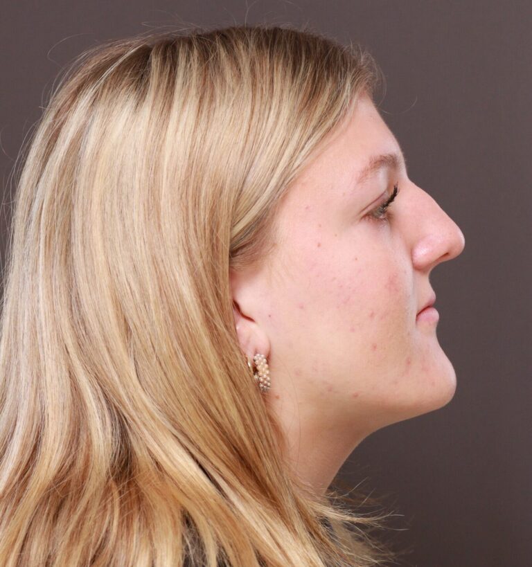 Before Image: Rhinoplasty by Dr. Manning - right-side