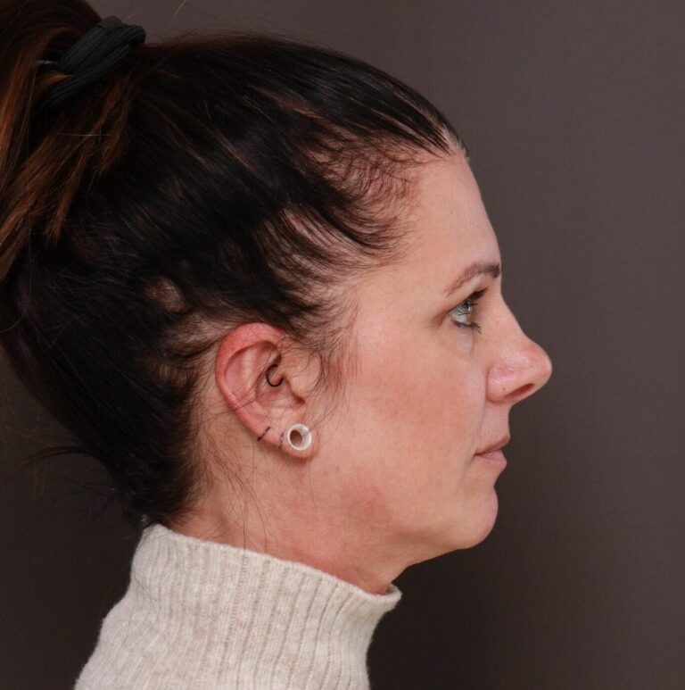 After Image: Otoplasty by Dr. Henstrom - right-side