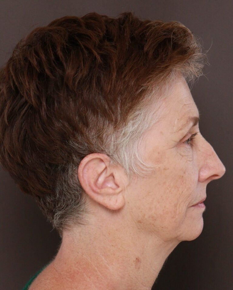 Before Image: Upper & Lower Blepharoplasty, Periorbital Fat Grafting and Contour TRL by Dr. Manning - right-side