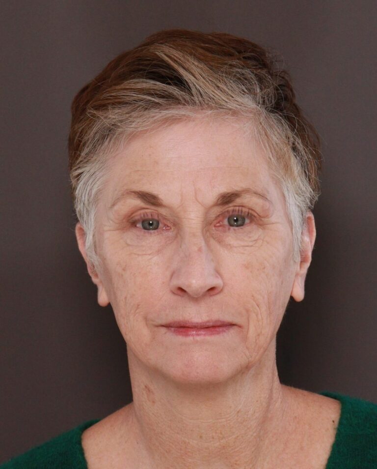 Before Image: Upper & Lower Blepharoplasty, Periorbital Fat Grafting and Contour TRL by Dr. Manning - front