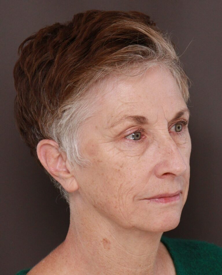 Before Image: Upper & Lower Blepharoplasty, Periorbital Fat Grafting and Contour TRL by Dr. Manning - right-front-oblique