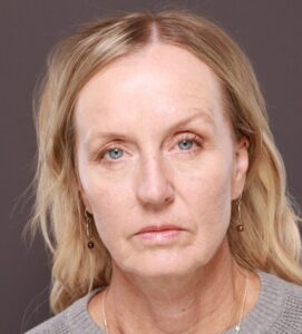 Before Image: Facelift & Forehead Reduction by Dr. Thompson