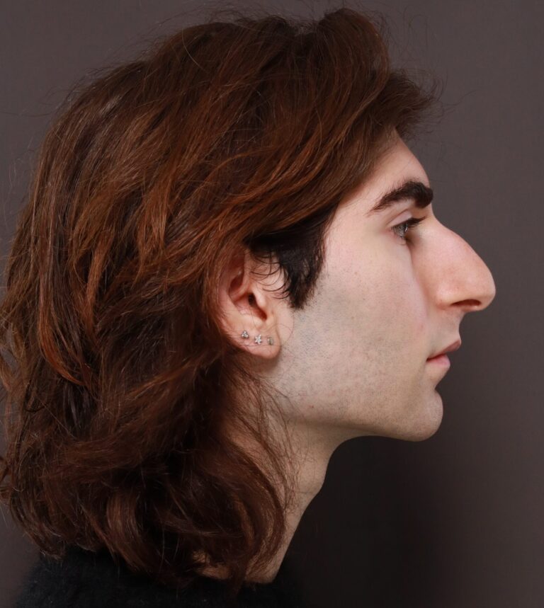 Before Image: Rhinoplasty by Dr. Henstrom - right-side