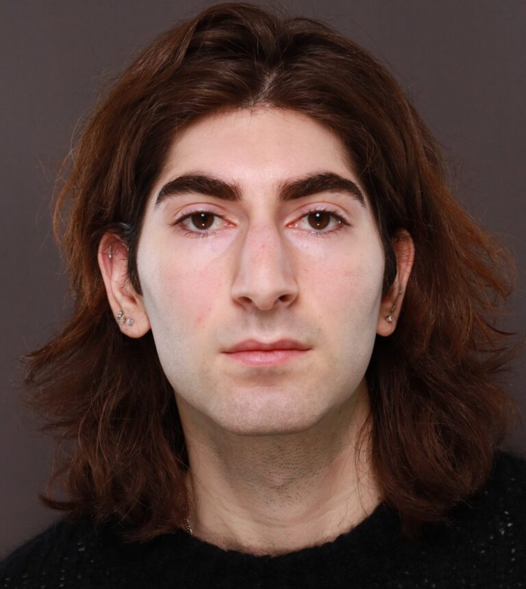 Before Image: Rhinoplasty by Dr. Henstrom - front
