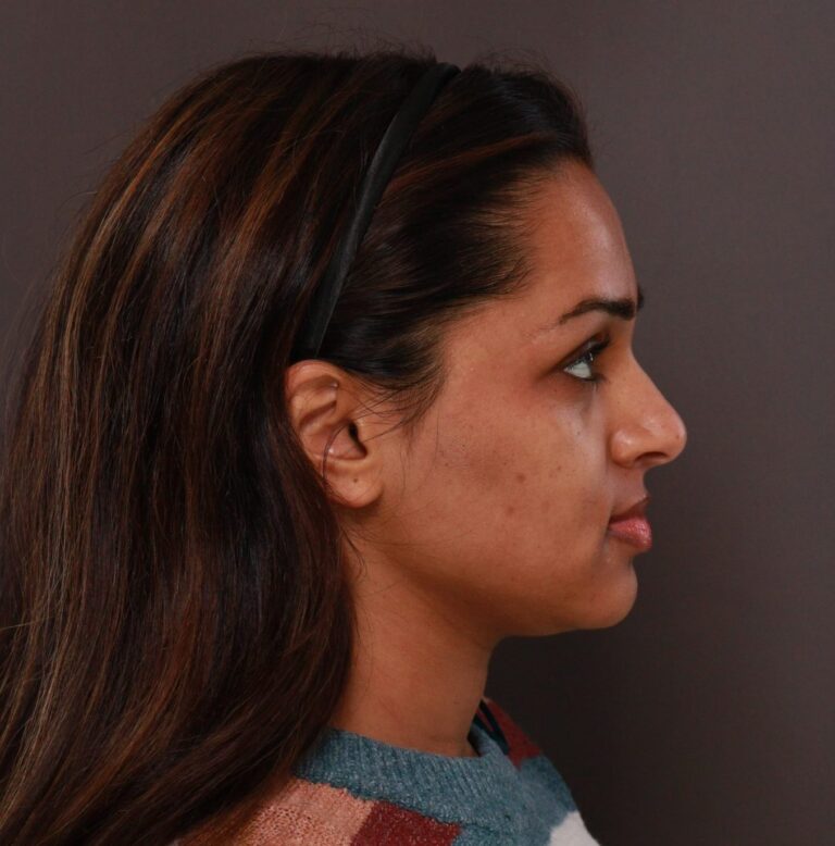 Before Image: Rhinoplasty by Dr. Manning - right-side