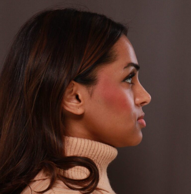 After Image: Rhinoplasty by Dr. Manning - right-side