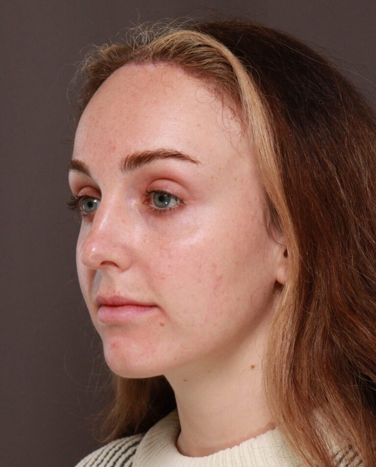 After Image: Forehead Reduction by Dr. Manning - left-front-oblique