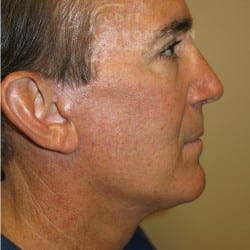 After Image: Facelift, Upper And Lower Blepharoplasty with Fat Repositioning, and Fat Transfer by Dr. Thompson - right-side