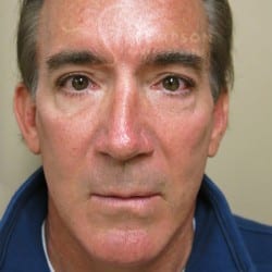 After Image: Facelift, Upper And Lower Blepharoplasty with Fat Repositioning, and Fat Transfer by Dr. Thompson - front