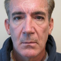Before Image: Facelift, Upper And Lower Blepharoplasty with Fat Repositioning, and Fat Transfer by Dr. Thompson - front