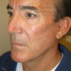 After Image: Facelift, Upper And Lower Blepharoplasty with Fat Repositioning, and Fat Transfer by Dr. Thompson - left-front-oblique