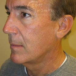 Before Image: Facelift, Upper And Lower Blepharoplasty with Fat Repositioning, and Fat Transfer by Dr. Thompson - left-front-oblique