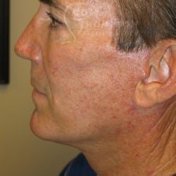 After Image: Facelift, Upper And Lower Blepharoplasty with Fat Repositioning, and Fat Transfer by Dr. Thompson - left-side