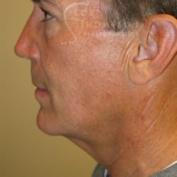 Before Image: Facelift, Upper And Lower Blepharoplasty with Fat Repositioning, and Fat Transfer by Dr. Thompson - left-side