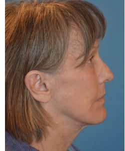After Image: Laser Resurfacing by Dr. Thompson - right-side
